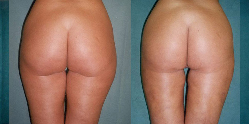 liposukce