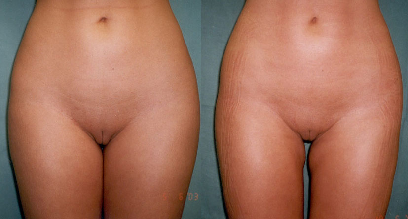 liposukce